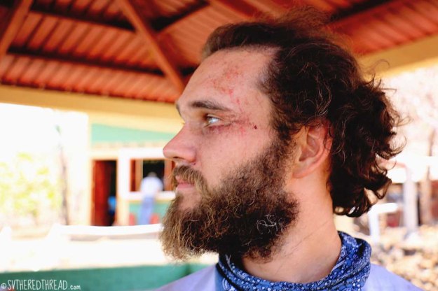 #Cerro Negro_Neil wounded2